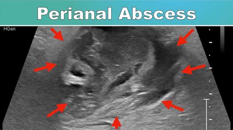 Perianal Abscess I Ultrasound YouTube