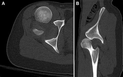 Anterior Hip Dislocation 5 Months After Hip Arthroscopy Arthroscopy