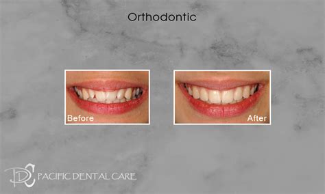 Retainers Teeth Straightening Glendale Pacific Dental Care