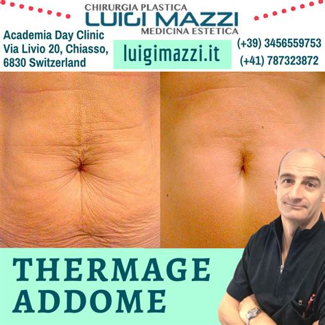 Dr Luigi Mazzi Thermage Addome Chirurgia Plastica Ed Medicina