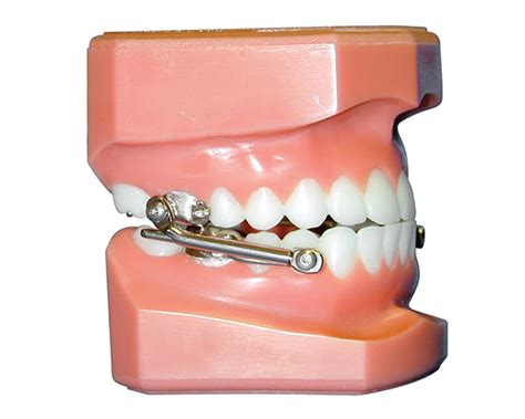 Fixed Functional Appliances Solas Orthodontics Perth