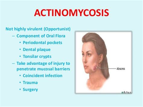 People At Risk With Actinomycosis • Having A Dental Disease Or Recent