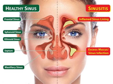 Can A Sinus Infection Be Treated At Home Store Head Hesge Ch