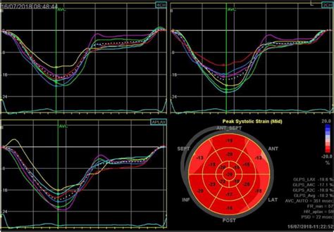 Three Dimensional Global Longitudinal Strain In The Left Ventricle An