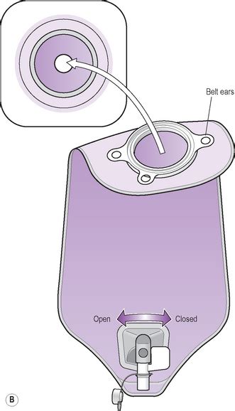 Stoma care | Nurse Key