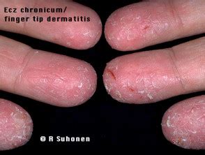 Immagini Di Dermatite Alle Mani Dermatly Il Tuo Sito Sulla Pelle