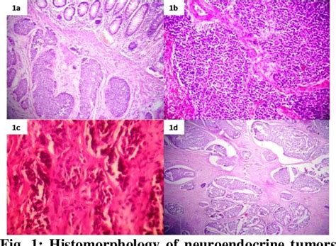 Table 1 From Clinicopathological Profile Of Neuroendocrine Tumors Of