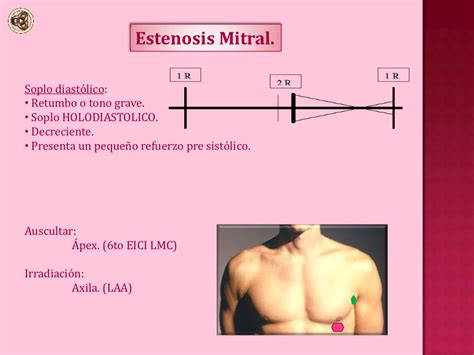 Soplos Cardiacos Estenosis Mitral