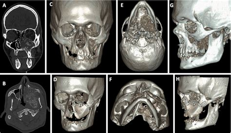 Current Trends In Midface Reconstruction And Use Of Virtual Surgical