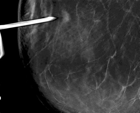 High Quality Biopsy Imaging With 2d Or 3dtm Tomosynthesis Imaging