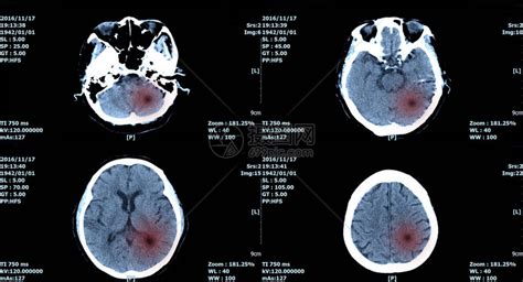 核磁共振扫描脑部ct扫描大脑图像诊断高清图片下载 正版图片504457951 摄图网
