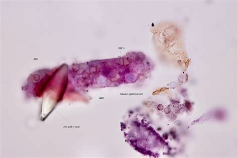 Rbc Cast In Urine