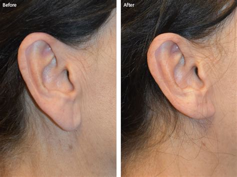 Earlobe Reduction Index Daniela Burchhardt Md