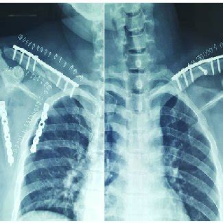 First X-Ray showing left midshaft clavicular fracture and comminuted ...