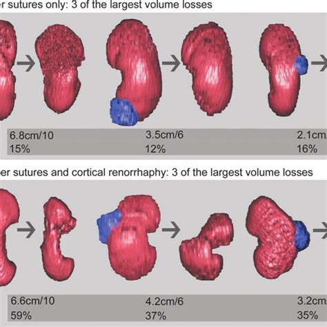 A Photo Of A Resected Small Renal Mass Showing Measurements To