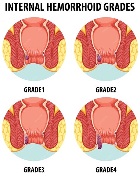 Premium Vector Illustrated Anatomy Of Human Internal Hemorrhoids In