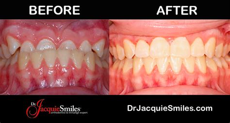 Invisalign Before and After Photos of NYC PatientsDr. Jacquie