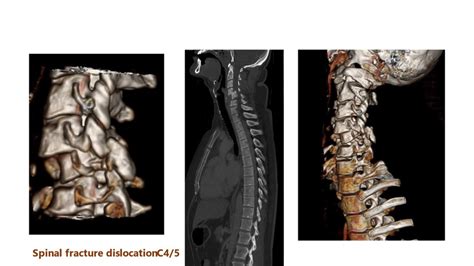 Single Ct Sagittal Reconstruction Of The Cervical Spine Demonstrates