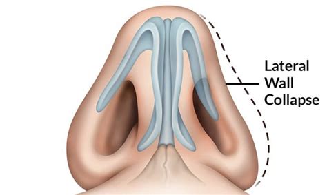 Nasal Valve Collapse Suburban Kidney Care