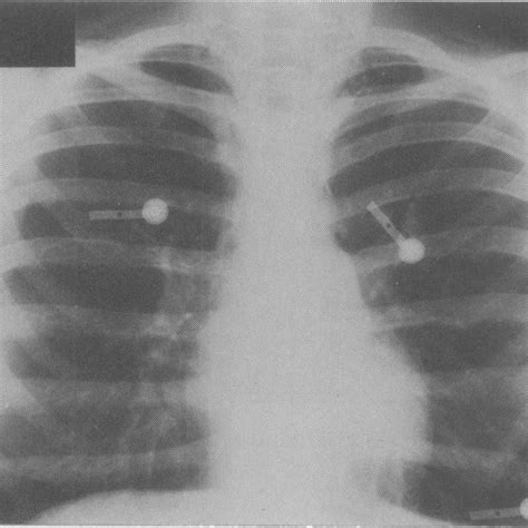 Pa Chest Radiograph On Admission Showing Air In The Mediastinum And Download Scientific Diagram