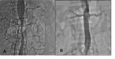 Figure 1 From Aortic Rupture During Aortoplasty In Takayasu Arteritis