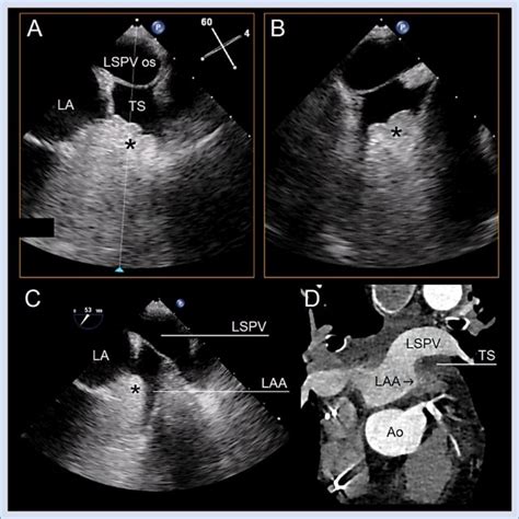 A B Biplane Transesophageal Echocardiography Mid Esophageal View An