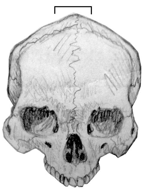 Metopic Suture Student Forensic Anthropology