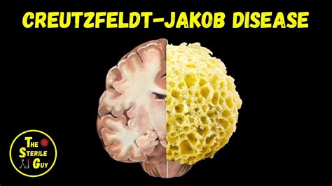Understanding The Differences Between Creutzfeldt Jakob 45 Off