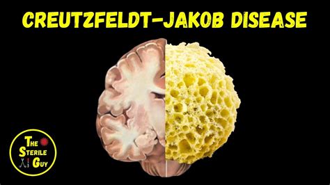 Creutzfeldt Jakob Disease Brain