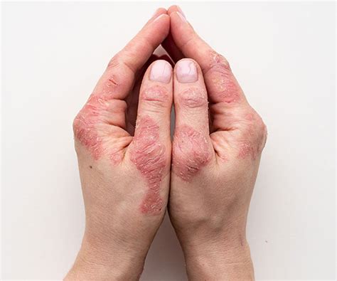 Psoriasis Su Piel Dermacenter