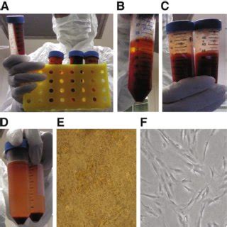 Isolation Of Stromal Vascular Fraction SVF From Patient S