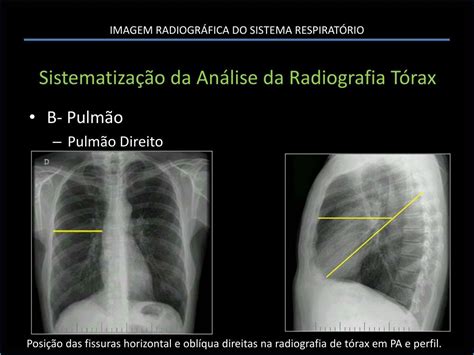 PPT Semiologia Radiográfica SISTEMA RESPIRATÓRIO PowerPoint