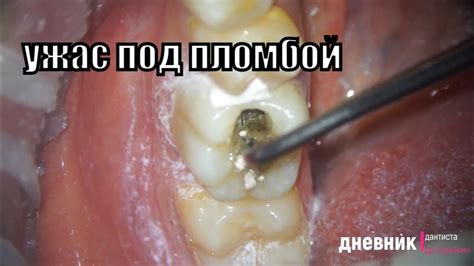 ужас под пломбой , убрали пломбу а там ? #стоматология #кариес #пульпит ...