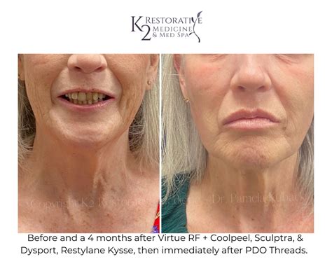 Before After Fillers Injectables At K2 Restorative Medicine