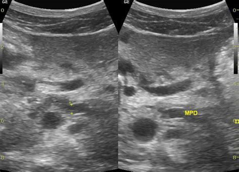 Pancreatic Ascites Image