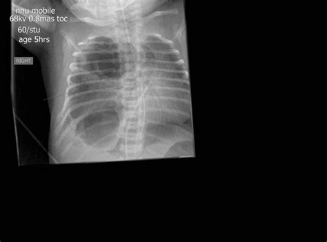 Congenital Pulmonary Airway Malformation Cpam Pacs