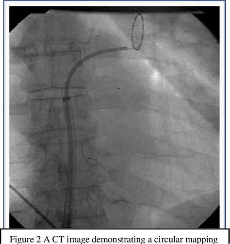 Figure 1 From Pulmonary Vein Isolation With The Cryoballoon Technique In The Management Of