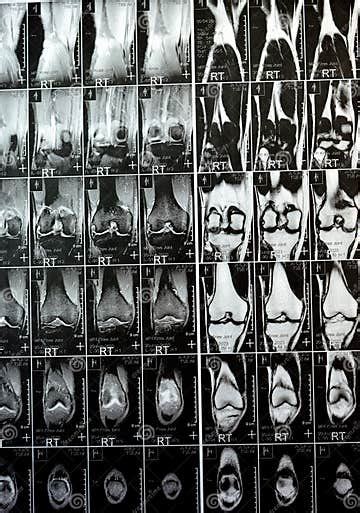 MRI of the Right Knee Showing Mild Joint Effusion, with Normal Other ...