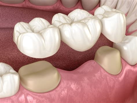 Qué es un puente dental Mini Implantes Dentales en Tampa Bay