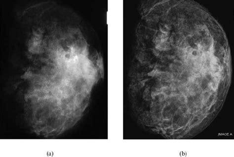 A Filmscreen And B 50 M M Computed Radiography Mammograms Of A