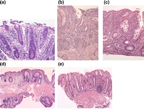 Histological Features Of Drug‐induced Mucosal Injury Dimi In The