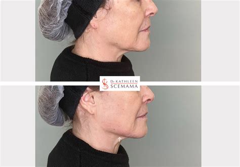 Jawline Injections D Acide Hyaluronique Paris Dr Kathleen Scemama