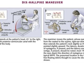 Vestibular Examination Dix Hallpike Maneuver For BPPV Epomedicine