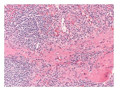 Hande Stained Slides Of The Splenosis Deposit Showing Splenosis