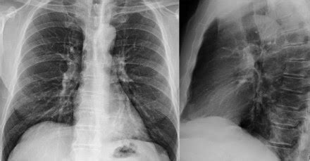 Chest Medicine Made Easy Dr Deepu Basics Of Chest X Ray Part