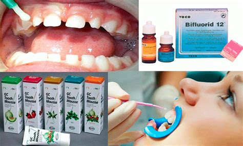 Фторирование молочных зубов - Стоматология Набережные Челны - DENTAL ...