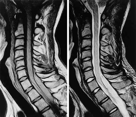 Figure From Cervical Epidural Hematoma After Snowboarding Injury