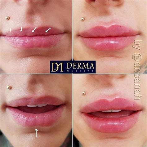 Diy Lip Filler Gone Wrong Oralia Burden