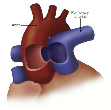 Aortopulmonary Window Radiology Key