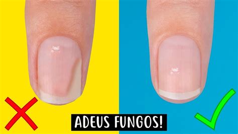 Como Acabar Com Fungos De Unhas Rapidamente Youtube